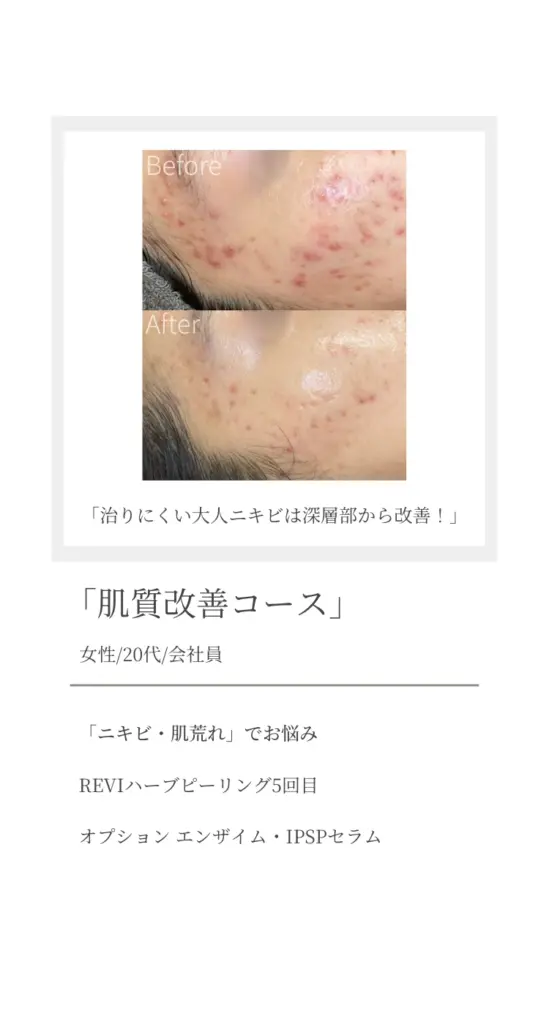 肌質改善コースのビフォーアフター症例画像。頬に広がる大人ニキビが、REVIハーブピーリングと酵素・IPSPセラムの施術で改善。『治りにくい大人ニキビは深層部から改善！』
