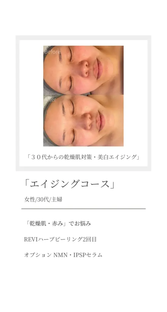 「30代女性主婦のエイジングケア症例。乾燥肌・赤みに悩む方への『エイジングコース』施術2回目のビフォーアフター。REVIハーブピーリングと、NMN・IPSPセラムのオプションを使用し、美白エイジングケアを実施。