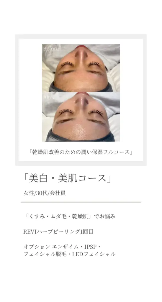 くすみ・ムダ毛・乾燥肌に悩む30代女性会社員の症例。『美白・美肌コース』1回目施術後のビフォーアフター。乾燥肌改善のための潤い保湿フルコースで、酵素・IPSP・LEDフェイシャルなど複数のオプションを使用。