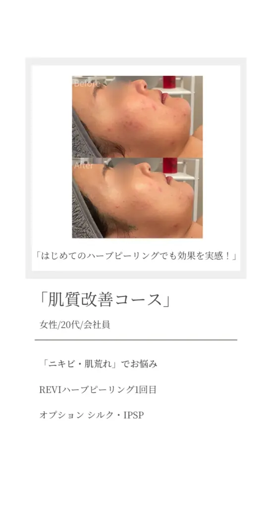 ニキビ・肌荒れに悩む20代女性会社員の症例写真。『肌質改善コース』のハーブピーリング初回施術後、赤みや凹凸が軽減されたビフォーアフター。シルクとIPSPのオプションを使用し、初回でも効果を実感した事例。